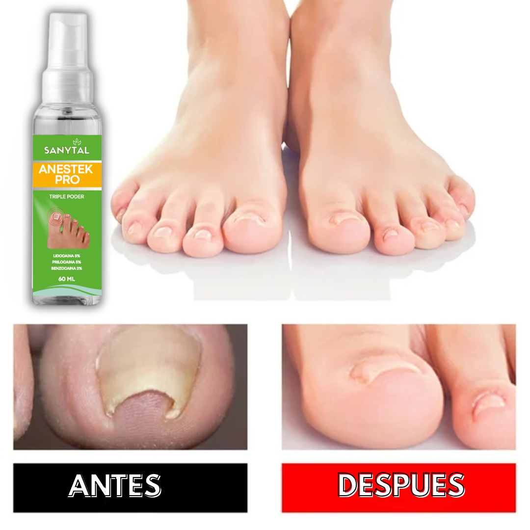 PACK PARA UÑEROS SIN DOLOR - (SPRAY ANESTÉSICO ANESTEK PRO + HERRAMIENTAS PODOLOGICAS) M0250