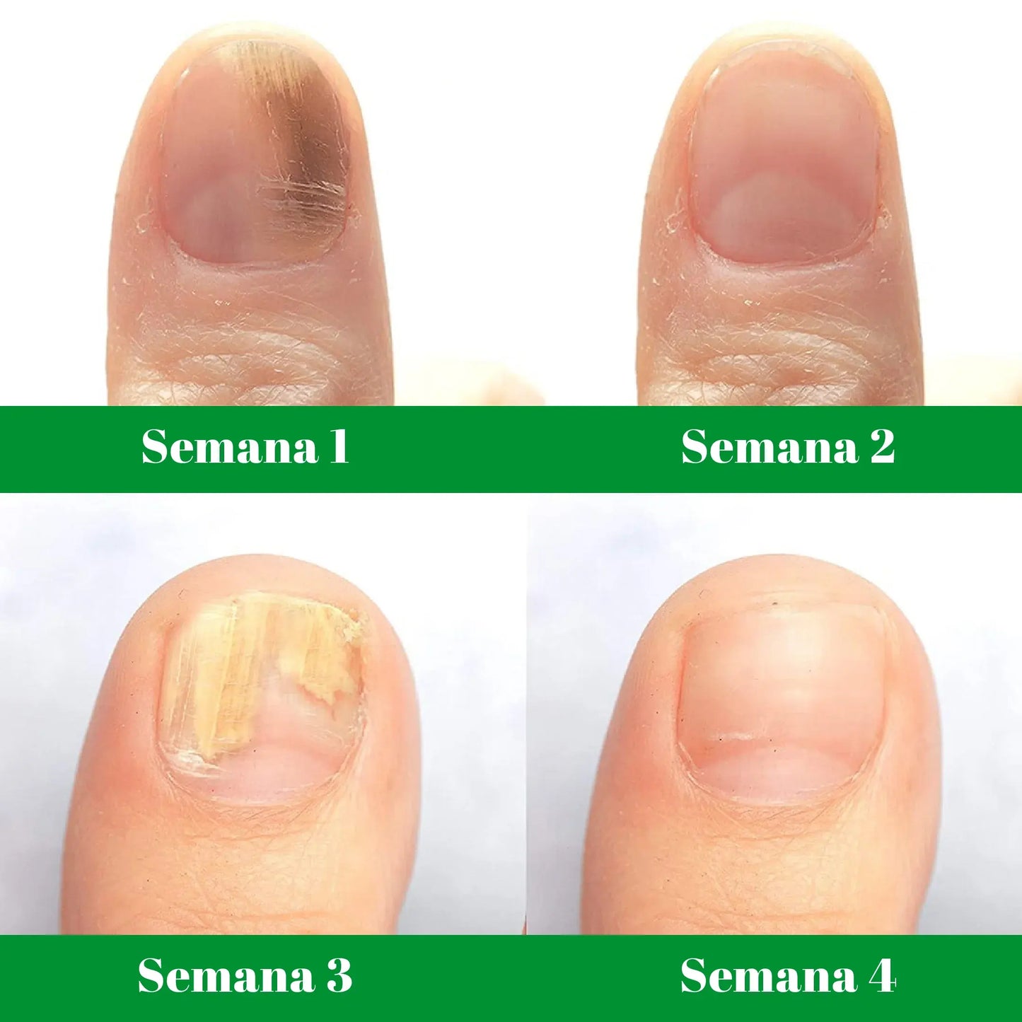PACK PODOLÓGICO (GOTAS DE TERBINAFINA + SYNDET ANTIMICOTICO+ KIT DE MANICURE Y PEDICURE 18 EN 1) - M0232