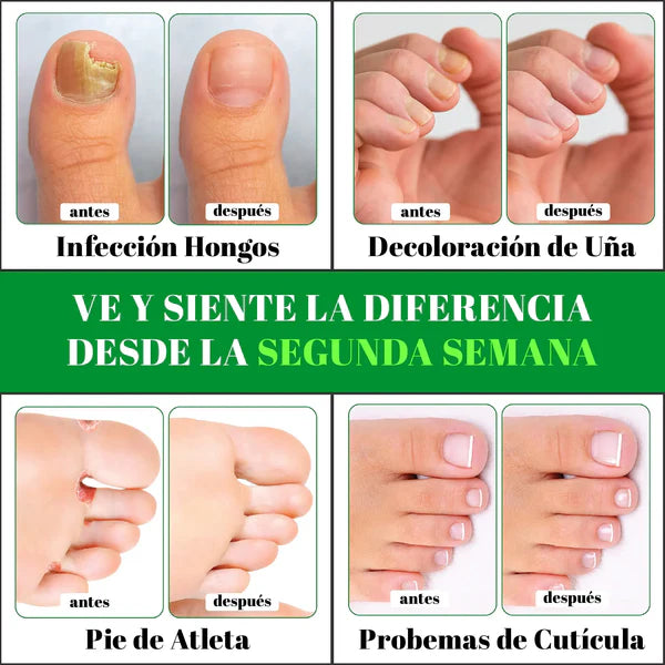 GOTAS DE TERBINAFINA PARA ELIMINAR LOS HONGOS - M003