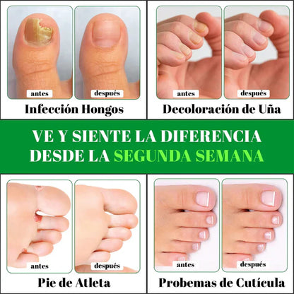 PACK ANTIMICOTICO (GOTAS DE TERBINAFINA + JABON ANTIMICOTICO (SYNDET) (ELIMINA HONGOS EN LAS UÑAS Y PIE DE ATLETA)- M0229