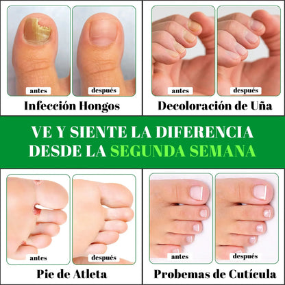 GOTAS DE TERBINAFINA PARA LOS HONGOS EN LAS UÑAS M001
